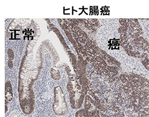 大腸癌のKLF5染色