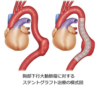 TAA_surgical_06
