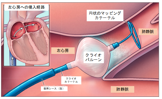 arrhythmia_catheter_03