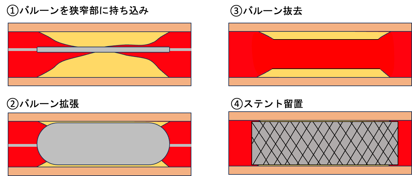 pad_catheter_01