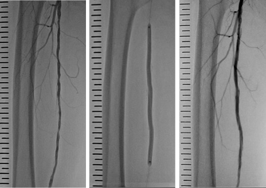 pad_catheter_02