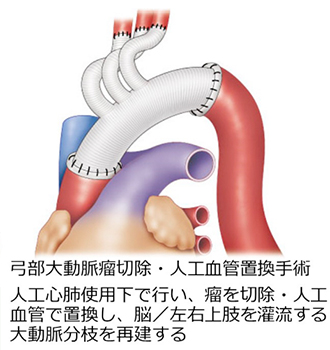 TAA_surgical_02