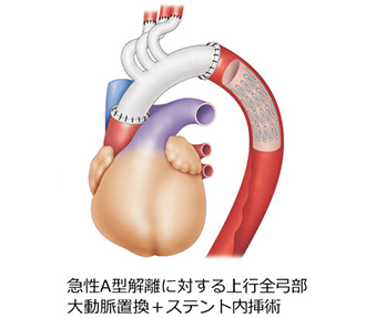 TAA_surgical_04