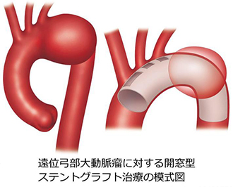 TAA_surgical_07