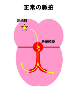 arrhythmia_01