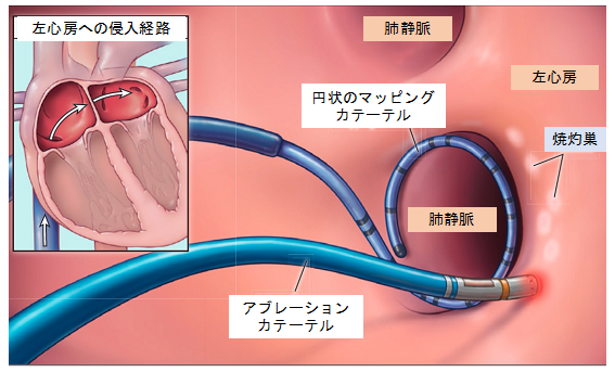 arrhythmia_catheter_02