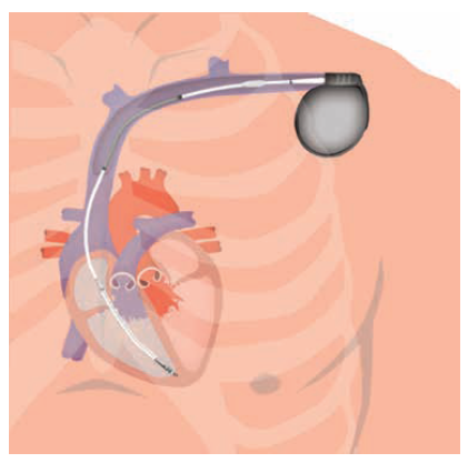arrhythmia_icd_01