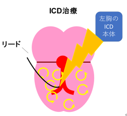 arrhythmia_icd_02