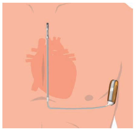 arrhythmia_icd_03
