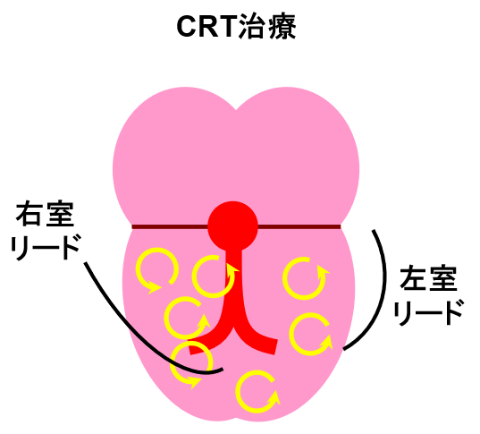 arrhythmia_icd_06