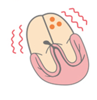 arrhythmia_surgical_01