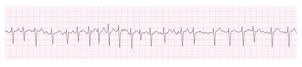 arrhythmia_surgical_02