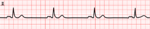 bradycardia_01