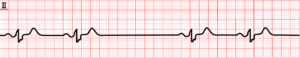 bradycardia_02