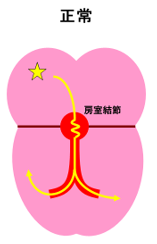 bradycardia_03