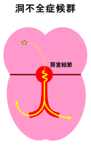 bradycardia_04