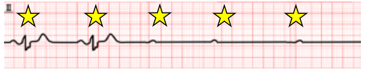bradycardia_05