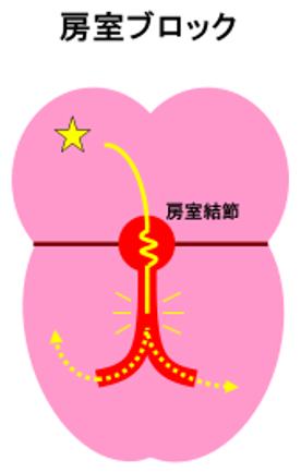 bradycardia_06