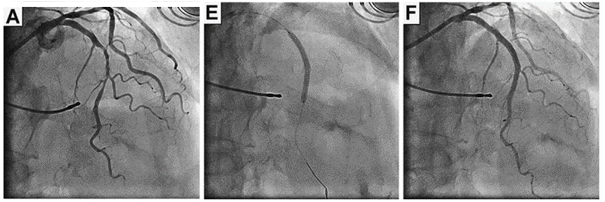 cad_catheter_01