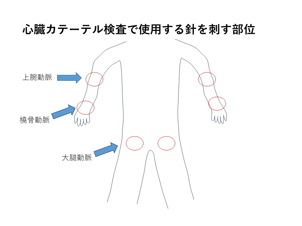 cad_catheter_02