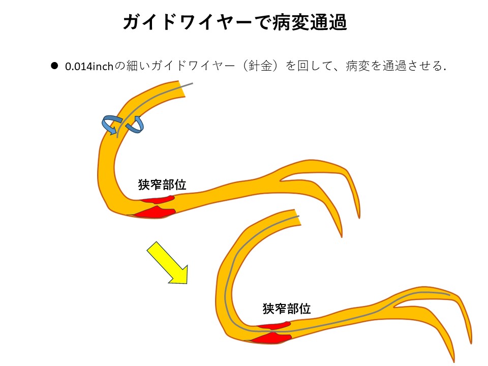 cad_catheter_03