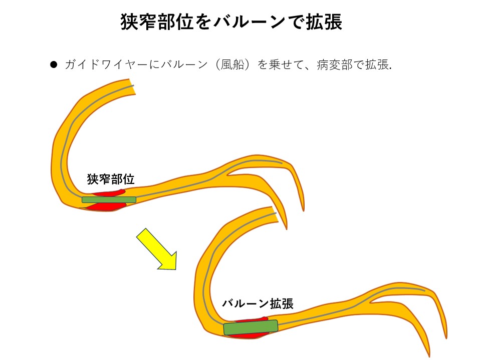 cad_catheter_04