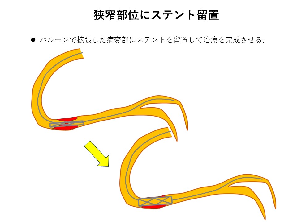cad_catheter_05