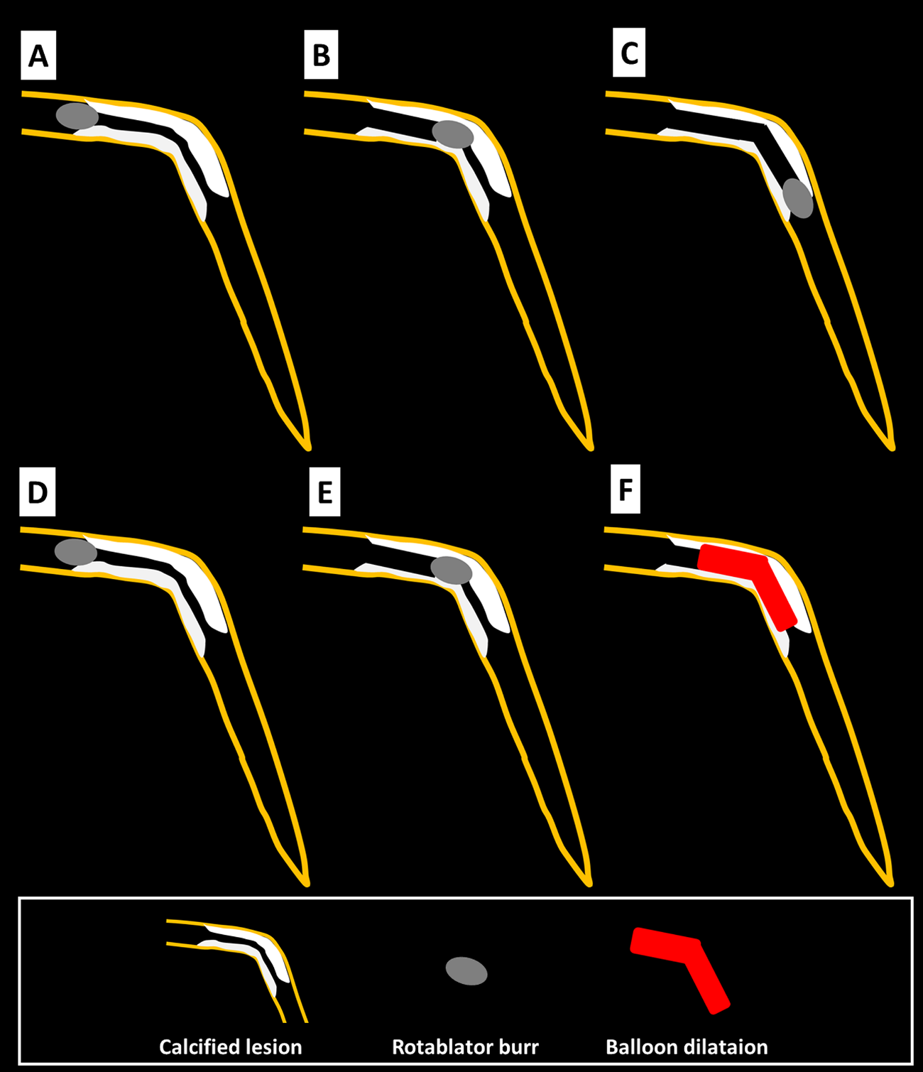 cad_catheter_achievement_04
