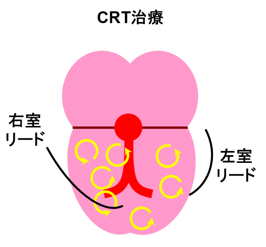 heart_failure_03