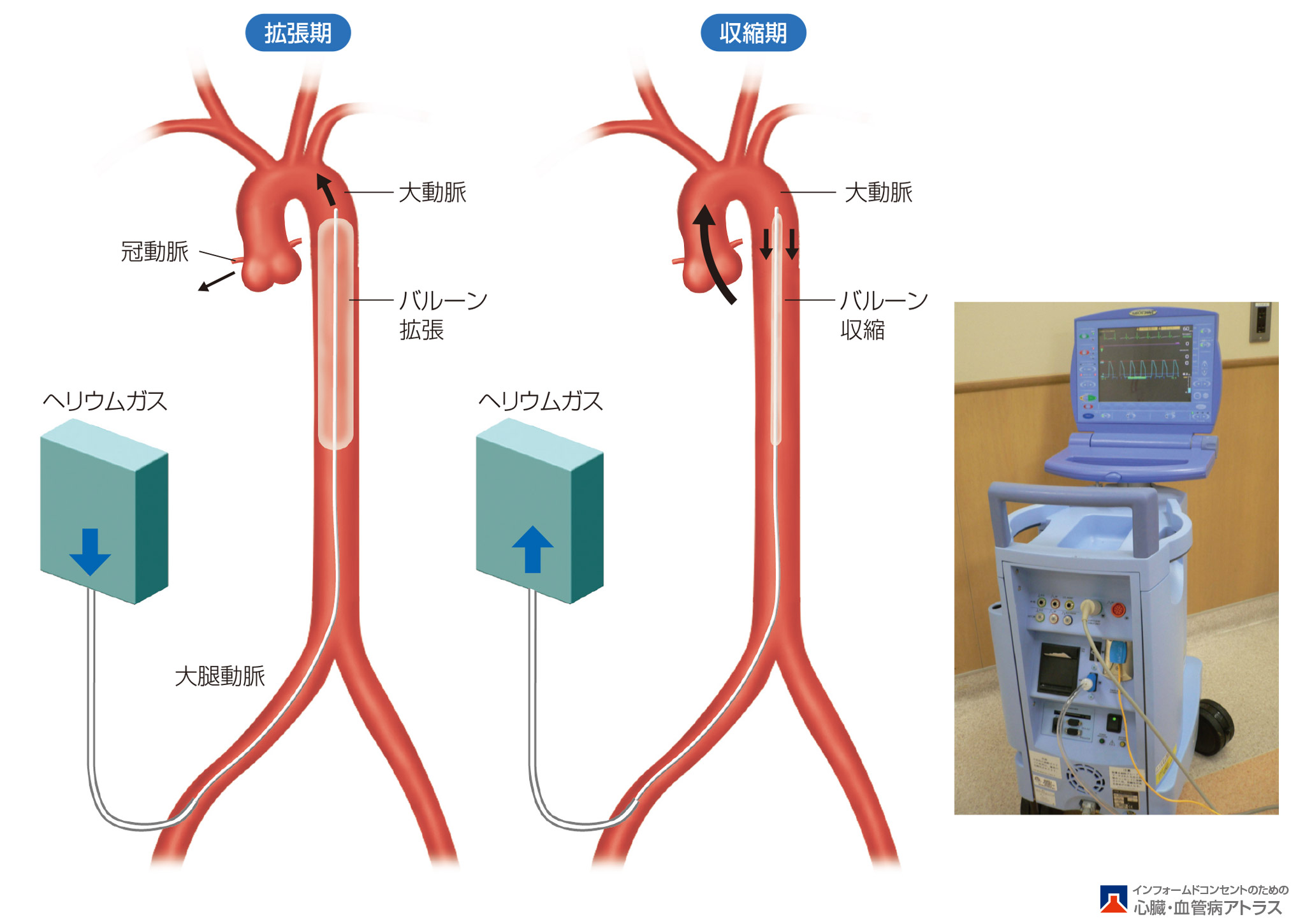 heart_failure_surgical_01