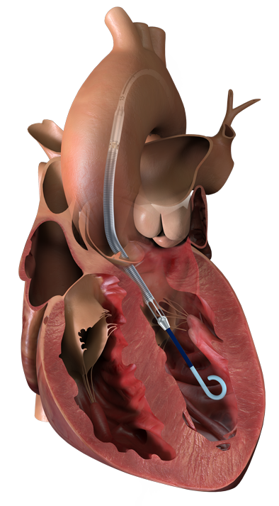 heart_failure_surgical_03