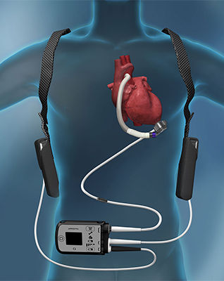 heart_failure_surgical_05
