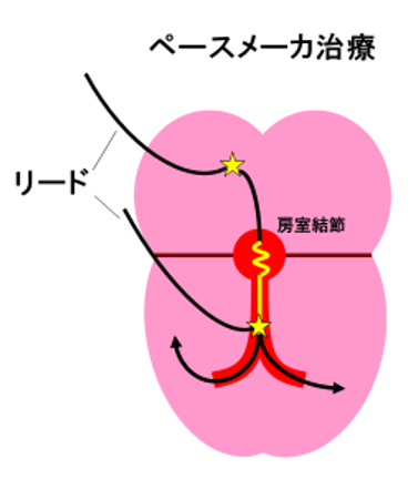 pacemaker_01
