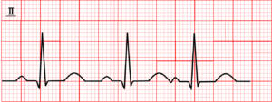 tachycardia_01