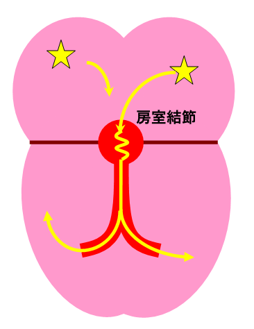 tachycardia_02