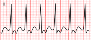 tachycardia_03