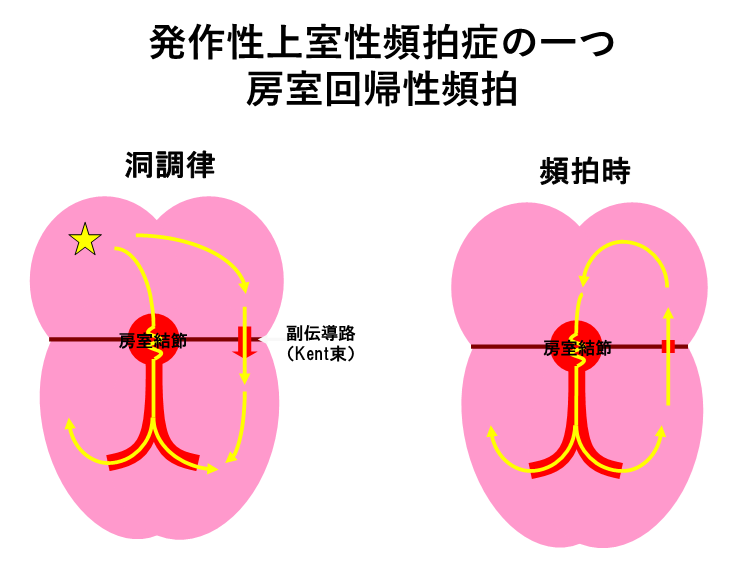 tachycardia_04
