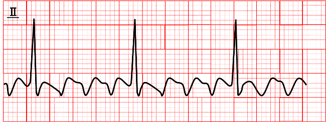 tachycardia_05