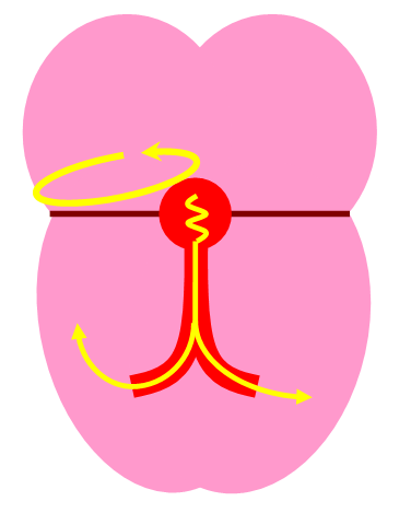 tachycardia_06