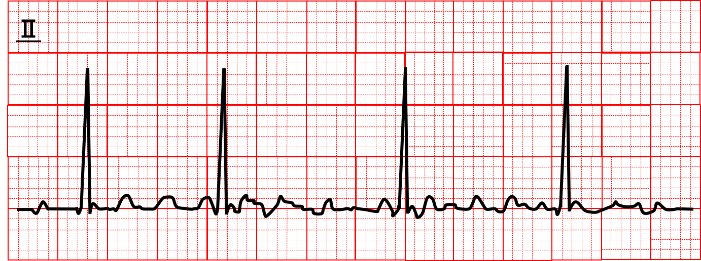 tachycardia_07