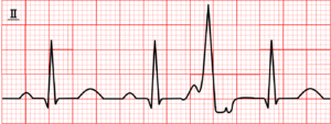 tachycardia_09