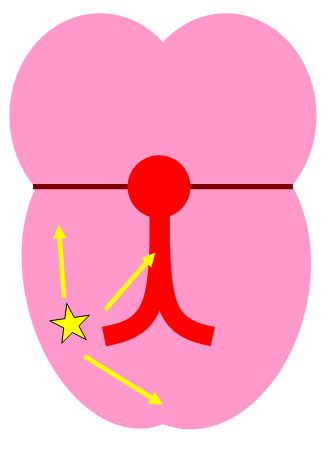 tachycardia_10
