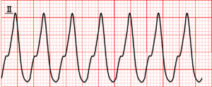 tachycardia_11