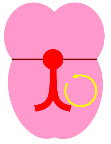 tachycardia_12