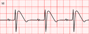 tachycardia_15