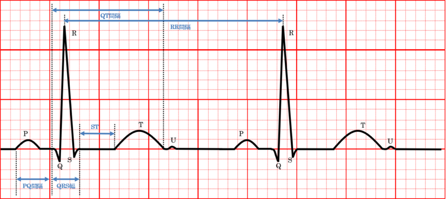 tachycardia_16