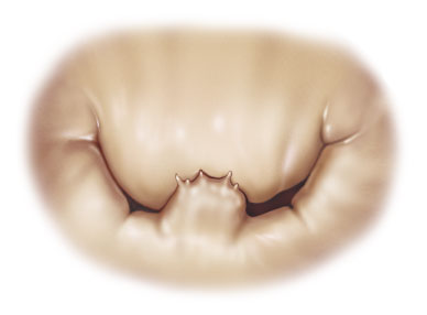 valve_surgical_01