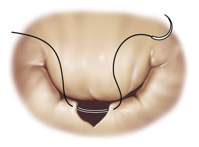 valve_surgical_02