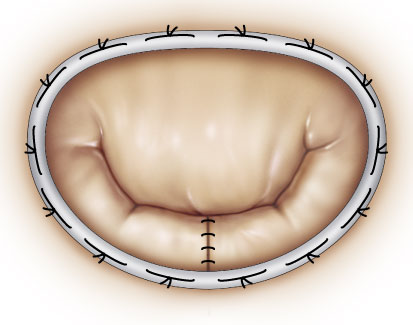 valve_surgical_03