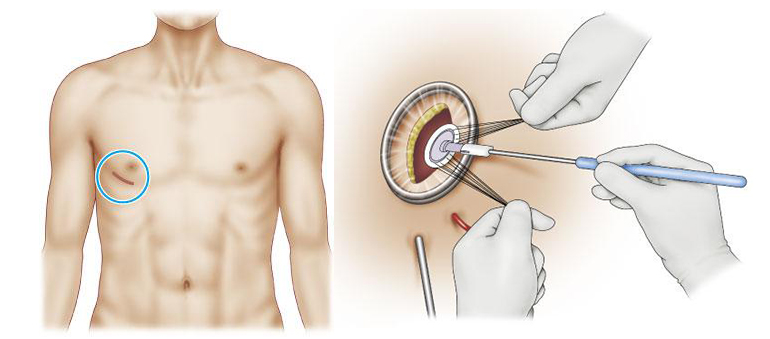 valve_surgical_05